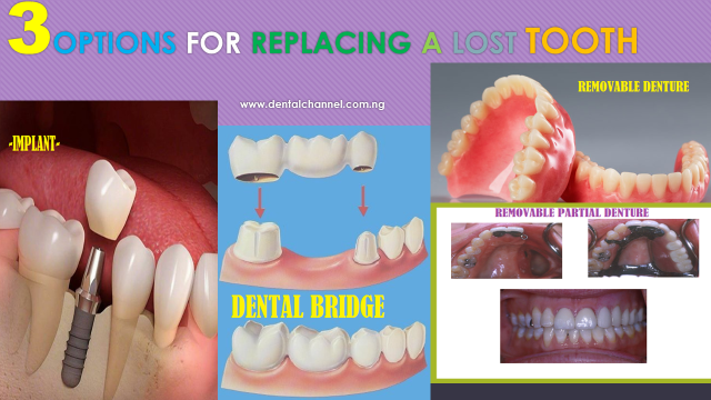 3 OPTIONS FOR REPLACING A LOST TOOTH